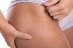 ¡Dile adiós a las estrías! Pon en práctica este tratamiento mágico olvídate de ellas por completo ¡Dile adiós a las estrías! Pon en práctica este tratamiento mágico olvídate de ellas por completo