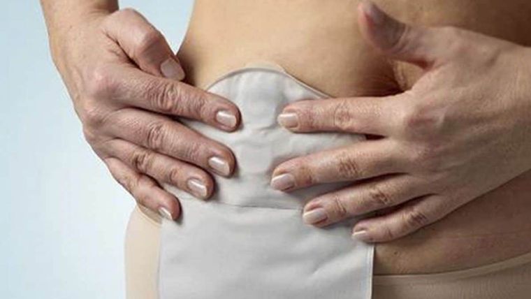 La ostomía puede ser temporal o permanente