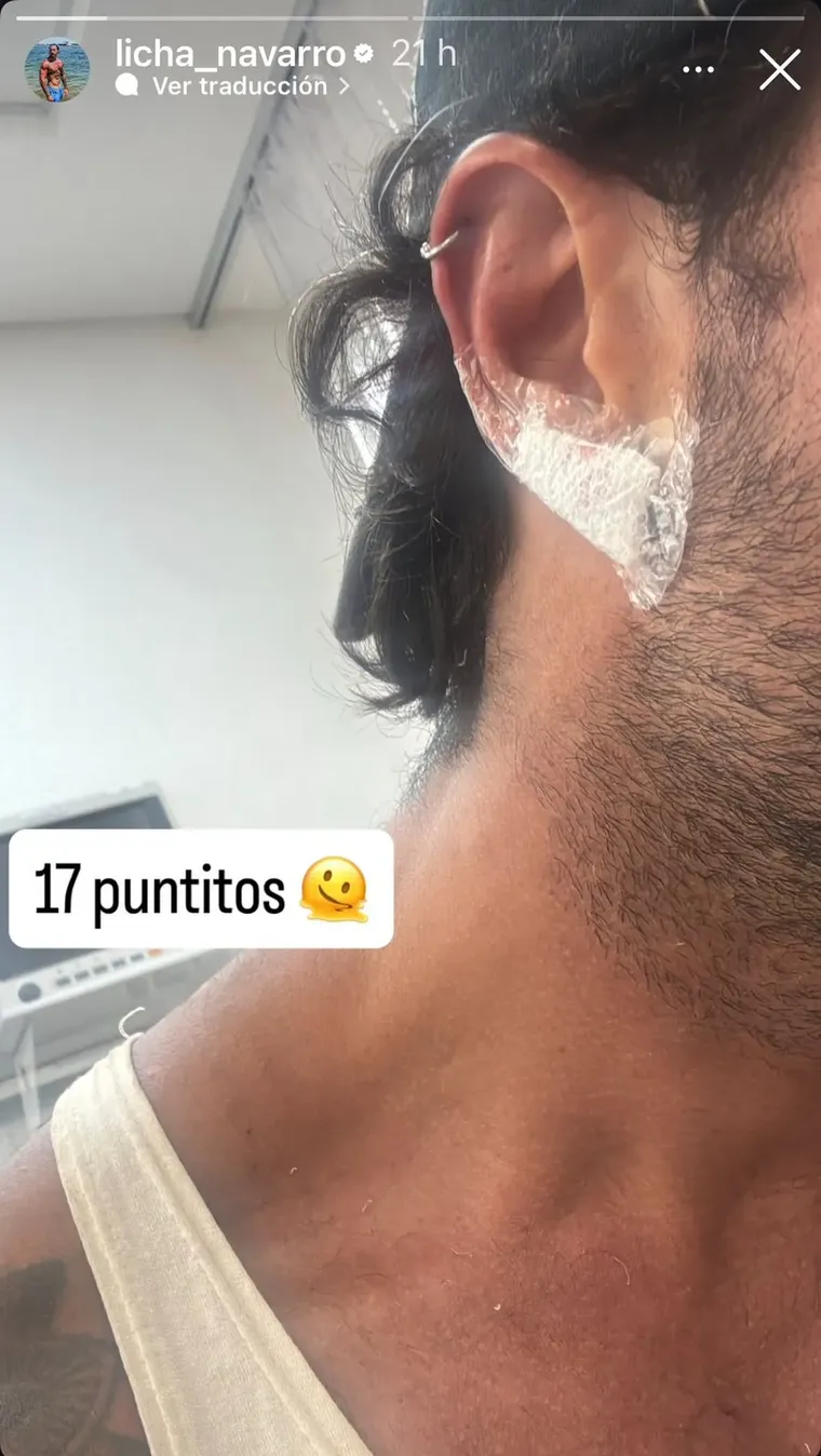 Lisandro Navarro impactó a sus fans con una foto de su oreja vendada tras recibir 17 puntos. Lisandro Navarro impactó a sus fans con una foto de su oreja vendada tras recibir 17 puntos.