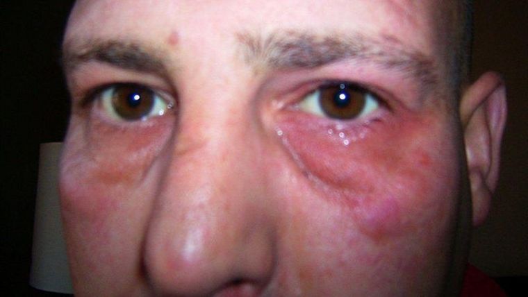 Un ataque comienza con el ojo izquierdo de Daren lloroso y caído