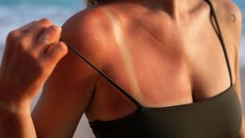 El verano y el sol intenso pueden dejar marcas en la piel. Foto: Freepik El verano y el sol intenso pueden dejar marcas en la piel. Foto: Freepik