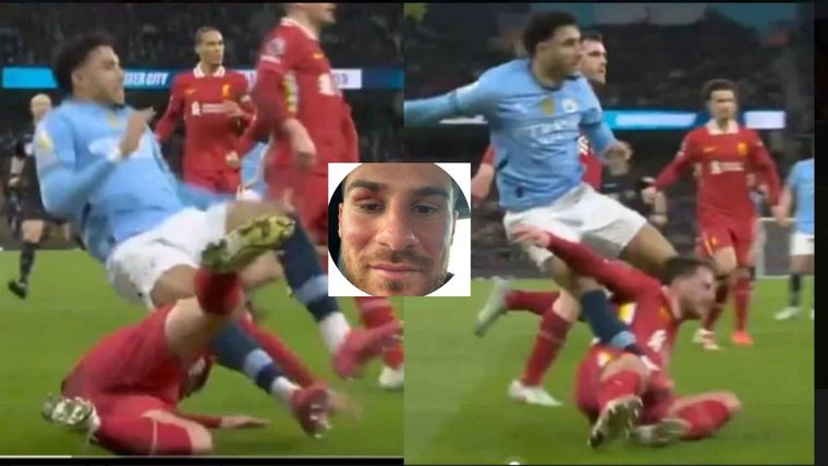 Mac Allister mostró como le quedó el rostro tras su choque con Marmoush. Foto: Captura de TV y @AlexisMacAllister