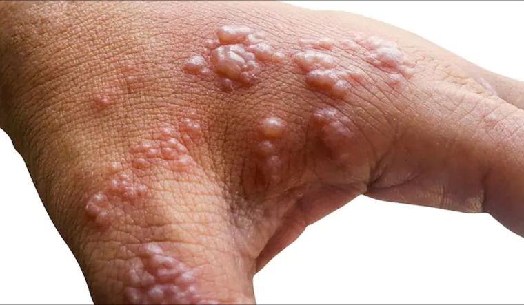 El Gobierno informó que ya son 5 los infectados con viruela del mono Foto: The Health Site