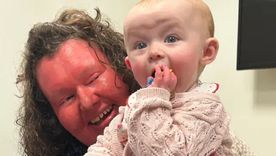 Georgina Burrough que nació con una condición de la piel extremadamente rara ya ha dado a luz a dos hijas sin pasarles su condición. Foto: BBC Mundo