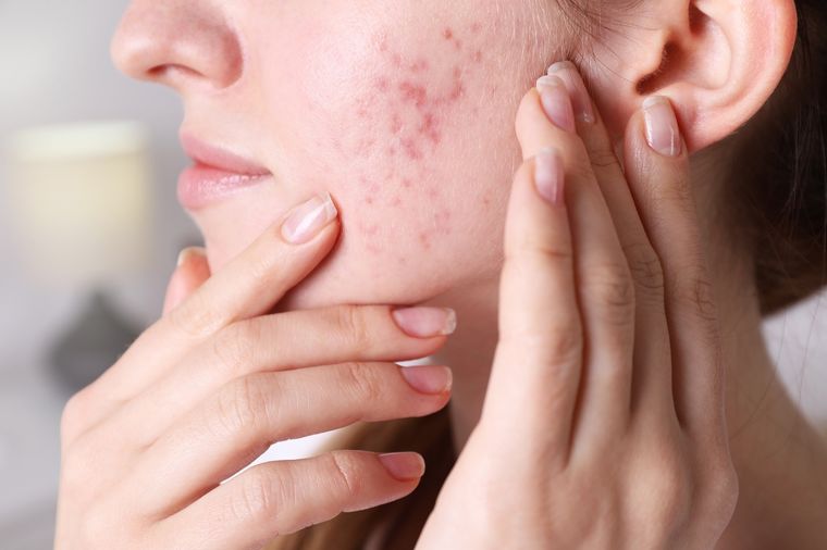 Acne Un sueño vinculado a la autoestima. Foto: Fuente: Shutterstock
