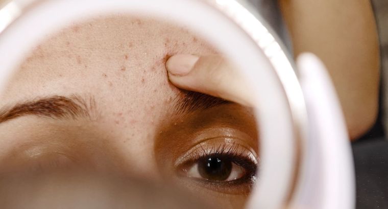 Acné en adultos: ¿por qué persiste aunque no seamos adolescentes? Foto: Eucerin