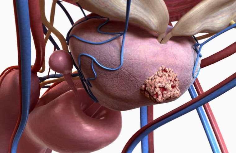 El 70% de los hombres no se realiza los controles hasta que no presentan síntomas de cáncer de próstata.
