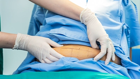 La resección de piel excedente, pero como un último paso dentro de una estrategia integral y no como el procedimiento principal. La resección de piel excedente, pero como un último paso dentro de una estrategia integral y no como el procedimiento principal.