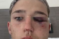 La víctima perdió sensibilidad en la mitad del rostro. La víctima perdió sensibilidad en la mitad del rostro.