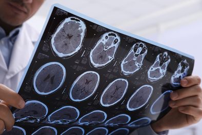 MDZol | Es importante detectar a tiempo la enfermedad para lograr un mejor tratamiento. Foto: Shutterstock