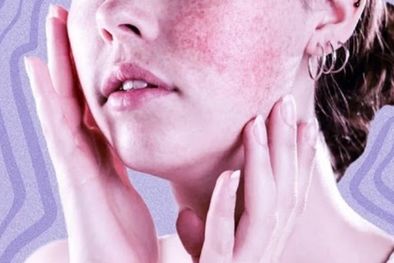 MDZol | Se estima que al menos 5 millones de personas en todo el mundo tienen lupus. Foto: MDZ