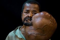 Hombre vivió cuarenta años con un gigantesco tumor