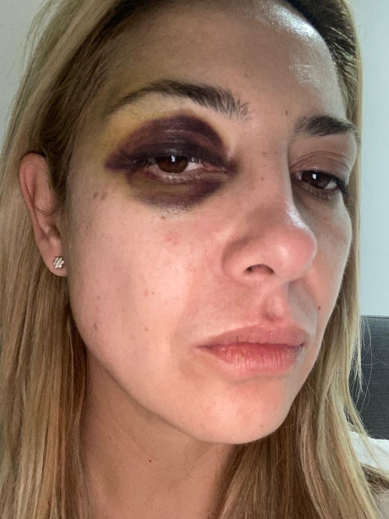 Fabiola le habría confesado a su esteticista que el moretón de su ojo lo causó Alberto, sin querer.