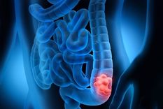 Existen distintas pruebas efectivas para detectar a tiempo el cáncer de colon. Foto: Archivo MDZ