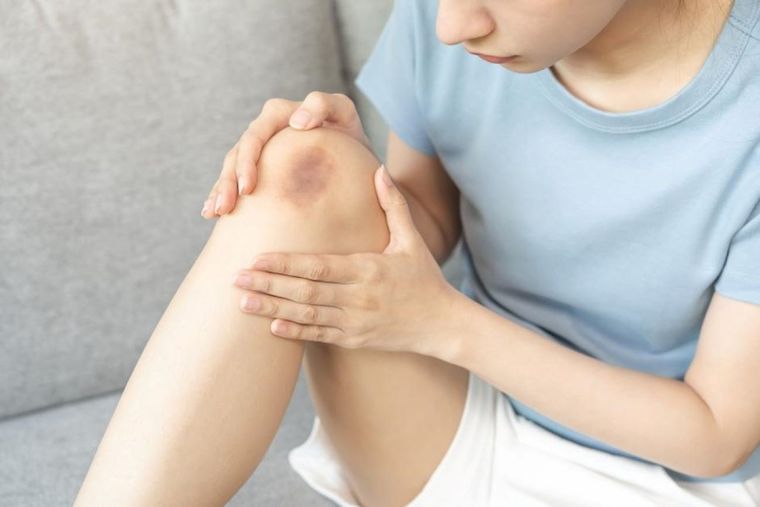 Estos alimentos reducen la inflamación de los moretones Foto: Shutterstock