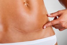 ¡Adiós cicatrices!