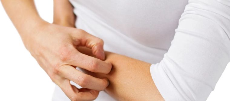 La picazón es uno de los síntomas más molestos de la dermatitis.