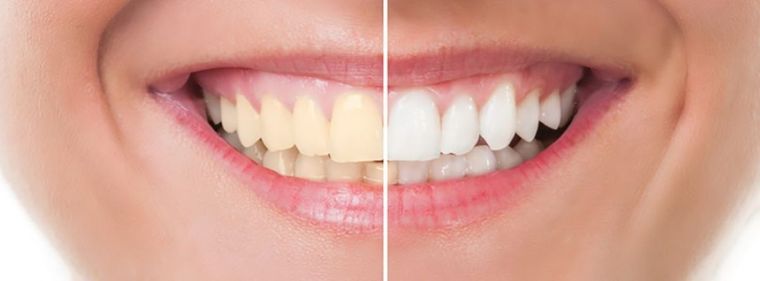 Este remedio casero, además de eliminar el color amarillo de los dientes, elimina el mal aliento Foto: Archivo