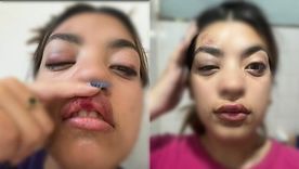 Personal médico constató hematomas en el rostro, costillas, brazos y piernas. Foto: X. Personal médico constató hematomas en el rostro, costillas, brazos y piernas. Foto: X.