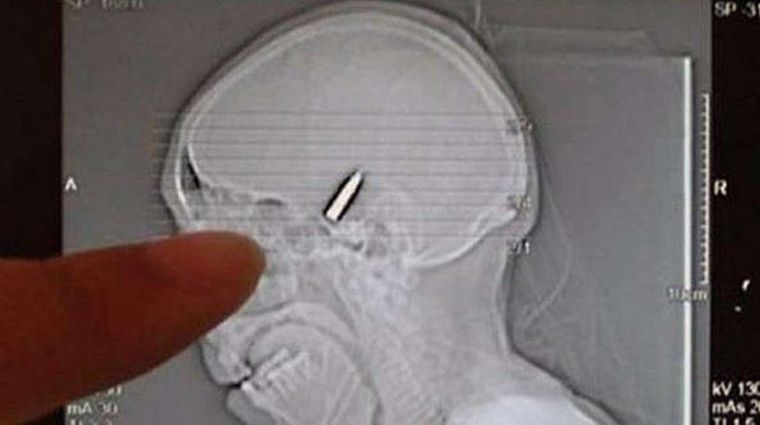 Tomografía donde se ve la bala en el cráneo. Foto: El Tribuno
