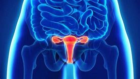 La endometriosis es una enfermedad inflamatoria crónica.