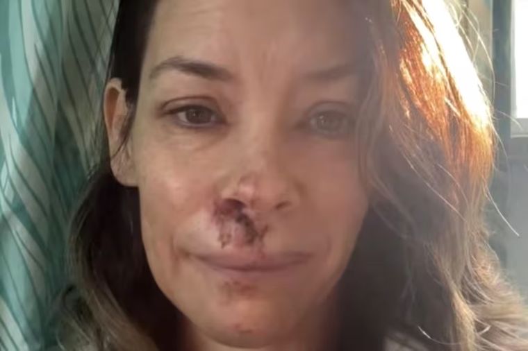 La imagen que compartió Evangeline Lilly tras su accidente en mayo pasado. La imagen que compartió Evangeline Lilly tras su accidente en mayo pasado.