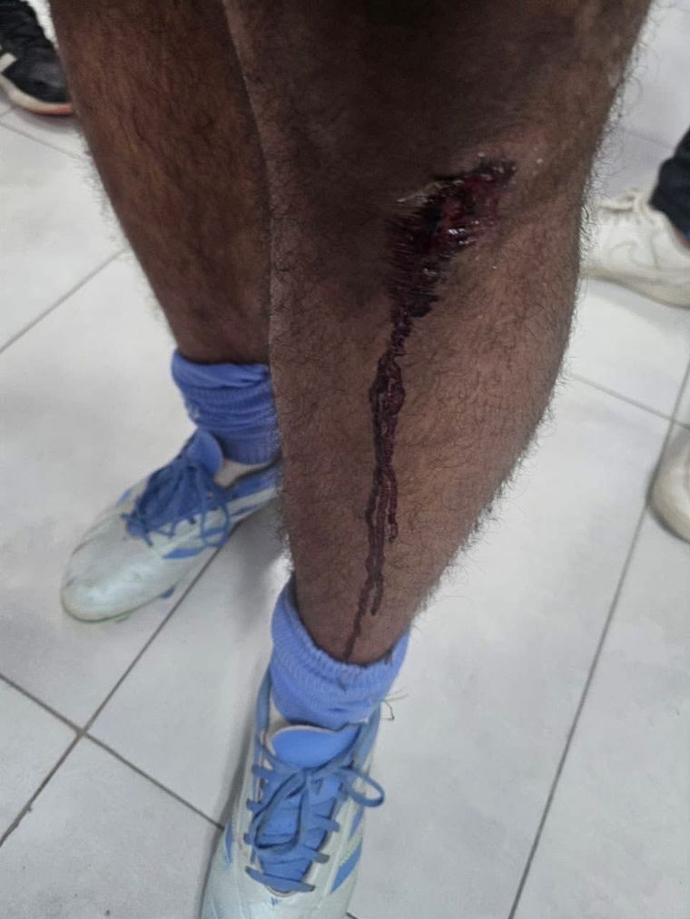 Otro de los jugadores agredidos tras el partido de la Liga Rivadaviense.