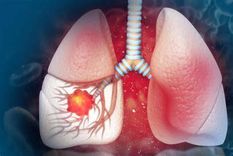 En el marco del Día Mundial del Cáncer de Pulmón, los especialistas coinciden en que la lucha contra esta enfermedad no solo depende de los avances médicos, sino también de la concientización y la detección temprana.