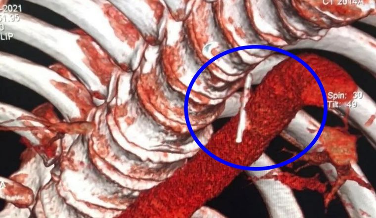 En la radiografía se ve claramente la aguja. Foto: Crónica