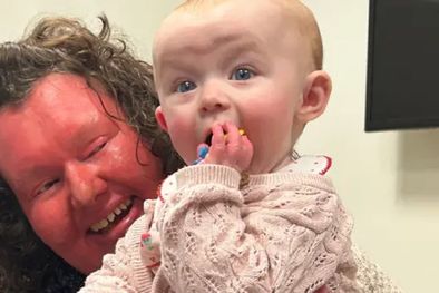 MDZol | Georgina Burrough que nació con una condición de la piel extremadamente rara ya ha dado a luz a dos hijas sin pasarles su condición. Foto: BBC Mundo