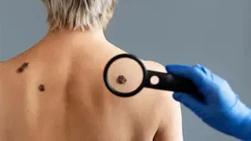 El Cáncer de Piel es una enfermedad que cuenta con mayores posibilidades de prevención y tratamiento. El Cáncer de Piel es una enfermedad que cuenta con mayores posibilidades de prevención y tratamiento.