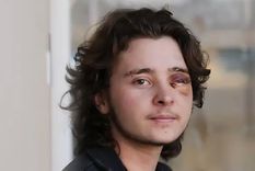 estoy vivo de milagro: perdio un ojo tras ser baleado por un agente de ice en una protesta estoy vivo de milagro: perdio un ojo tras ser baleado por un agente de ice en una protesta