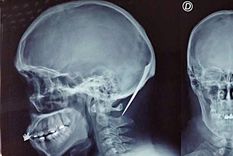 El hombre identificado como Oscar Zelada Jaldin fue operado y permanece fuera de peligro