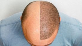 Chau calvicie: consejos de Harvard para recuperar el pelo Chau calvicie: consejos de Harvard para recuperar el pelo