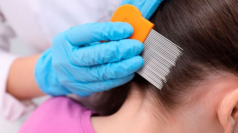 Dile adiós a los piojos con estos remedios naturales Foto: Shutterstock