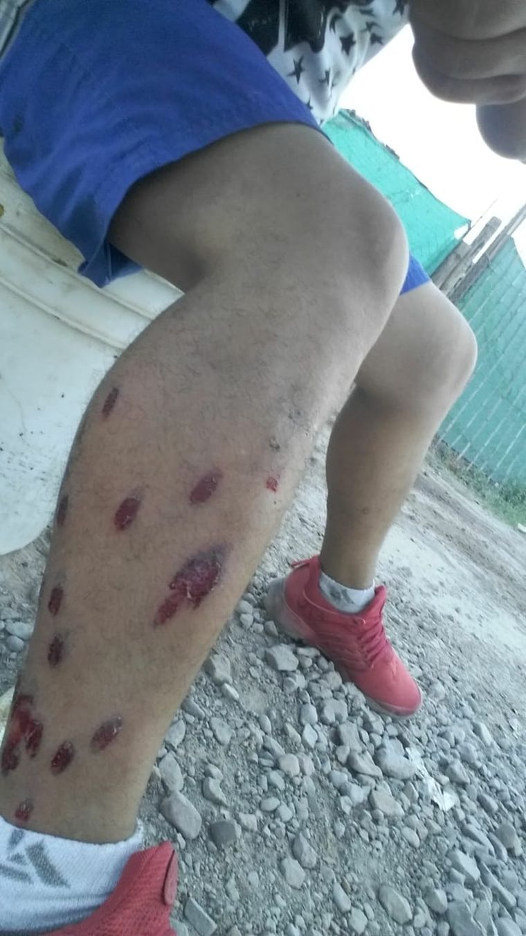 democracia Daniel Alvarado (28) recibió ayer el impacto de varias balas de goma. Otros vecinos sostienen que hubo gases dentro del barrio.