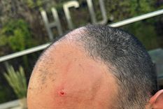 La cabeza de Santiago Santurio después del piedrazo