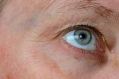 La rosácea es una enfermedad de la piel producida por distintos factores. Foto: Shutterstock