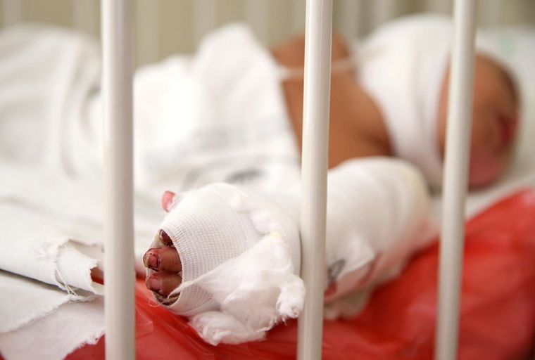 El niño quemado está internado con graves heridas en buena parte de su cuerpo