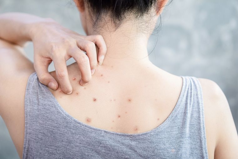 Muchas mujeres se sienten inseguras por mostrar su espalda con acné o cicatrices. Foto: Shutterstock.