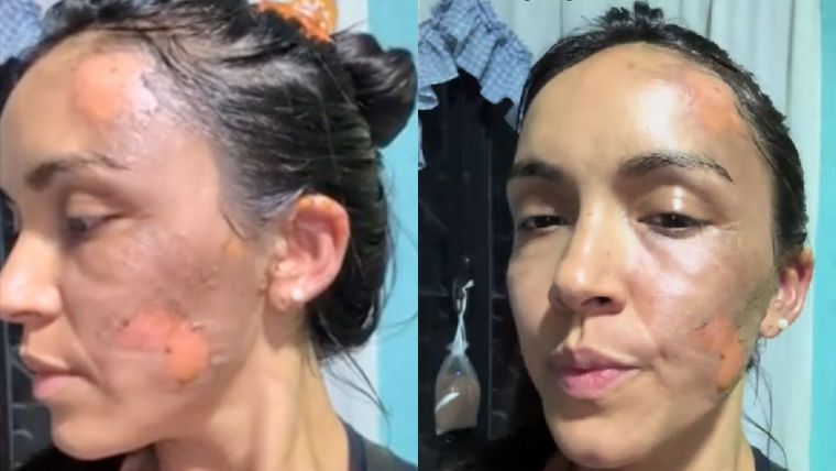 Así quedó la mujer tras ser atacada.