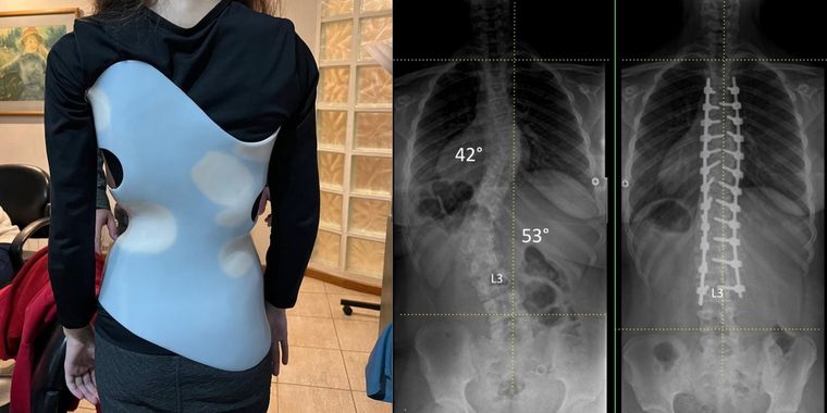 Paciente con corset y placa de un antes y después de la cirugía. Foto: Martín Estefan