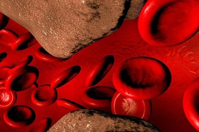 MDZol | Determinados tipos de lipoproteínas, cuando se elevan demasiado, corren serios riesgos de incrustarse en las paredes de nuestras arterias produciendo las temidas placas de ateroma. Foto: GETTY IMAGES