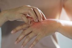 Las personas que tienen dermatilomanía pueden pellizcar o rascar lunares, pecas, marcas o cicatrices para suavizarlos o perfeccionarlos.