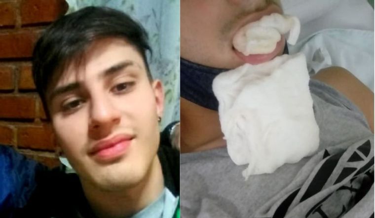 Facundo lleva 20 días esperando para que le coloquen cuatro placas de titanio tras un violento ataque en San Martín