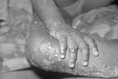 Lesiones en seres humanos producidas por la viruela símica. Foto: Wikipedia. Lesiones en seres humanos producidas por la viruela símica. Foto: Wikipedia.