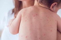 alerta por el virus del sarampion en circulacion