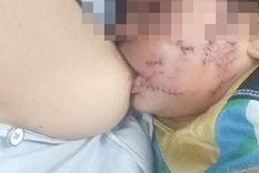 La pequeña recibió cincuenta puntos en el rostro Foto: El Tribuno