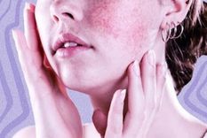 Se estima que al menos 5 millones de personas en todo el mundo tienen lupus. Foto: MDZ