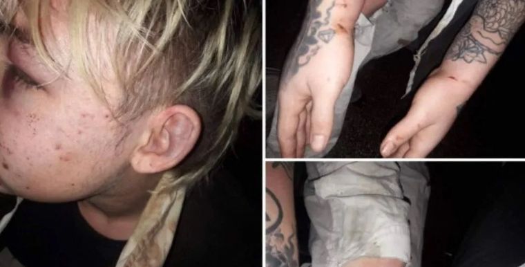 El joven mostró las heridas que le causaron los policías denunciados